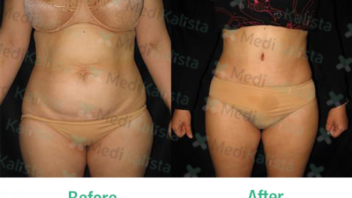 Liposuction in Tunisia: prices, clinics, conditions - Medikalista