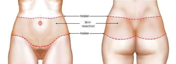 Body Lift Surgery  Perfection Plastic Surgery And Skin Care